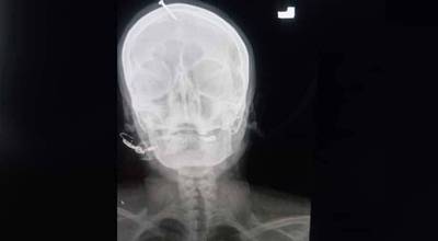 懷第4胎遭夫威脅生不出兒子就離婚  女誤信偏方5cm釘子親手釘腦袋